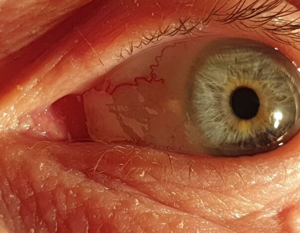 Highly Aberrated Cornea